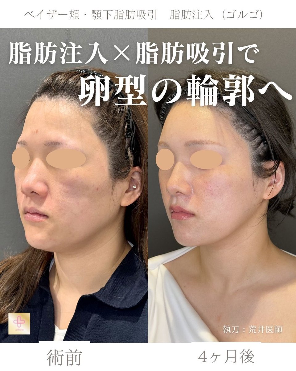 UBクリニック錦糸町院長👩‍⚕️荒井香織@目元整形、クマ取り、ベイザー脂肪吸引の美容外科医 tweet media