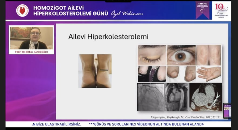 MeralKayikcoglu's tweet photo. FH Turkey conducted a livewebinar for #HoFH awareness day. Experts answered pts’ questions for hour. It was a truly valuable & engaging session. Thanks to all patients & families for questions & sincere thanks to experts for their time and dedication. #FHTurkiye https://t.co/hxF3RmttAr