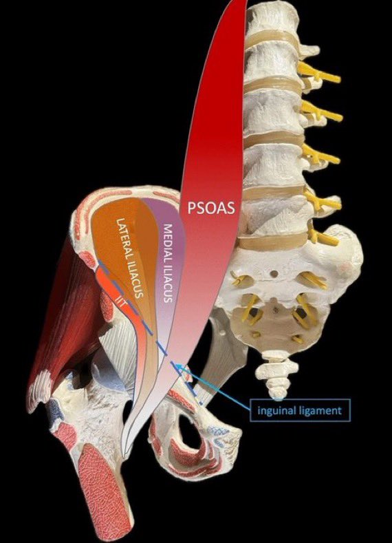 alsllmii's tweet photo. دراسة حديثة:

الرياضيون الذين يعانون من ألم ظهر مزمن، عضلة الـ Psoas (القطني) عندهم أكثر صلابة بشكل واضح مقارنة بالرياضيين الأصحاء؛ بفارق يصل إلى 17% في الجانب المؤلم

بمعنى المشكلة ماهي في ضعف الـ Psoas ولا في قصرها؛ المشكلة في صلابتها وتيبّسها

وهذا مهم جداً للمعالج، لأن كثير من البروتوكولات التقليدية تركز على الاستطالة أو التقوية.. لكن الدراسة تقول المشكلة ربما في طبيعة النسيج نفسه