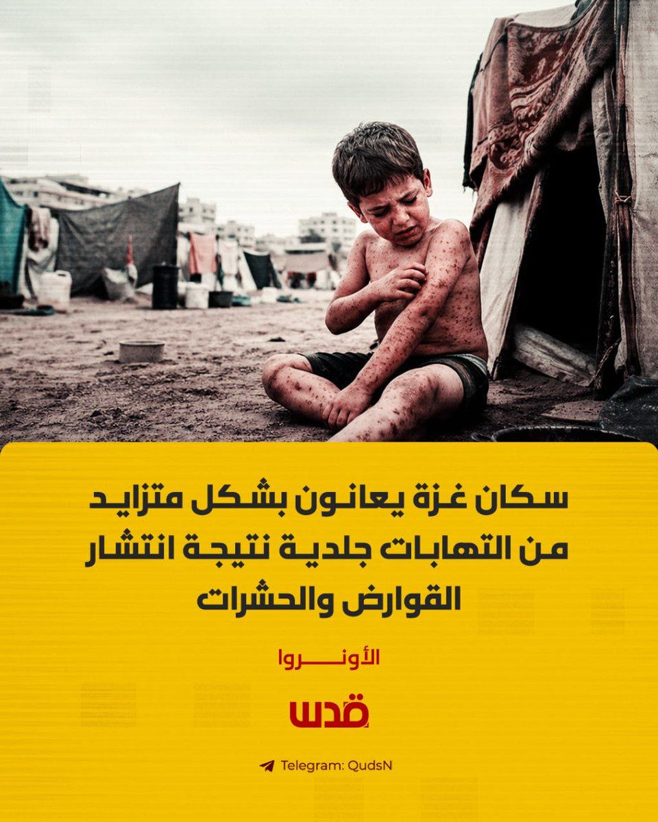 الأونروا: سكان غزة يعانون بشكل متزايد من التهابات جلدية نتيجة انتشار  القوارض والحشرات

- فرقنا تعالج نحو 40% من حالات الالتهابات الجلدية المقدرة بالآلاف في قطاع غزة

- غزة تعاني من نقص حاد في الأدوية الأساسية والعديد من الأطفال محرومون من العلاج اللازم