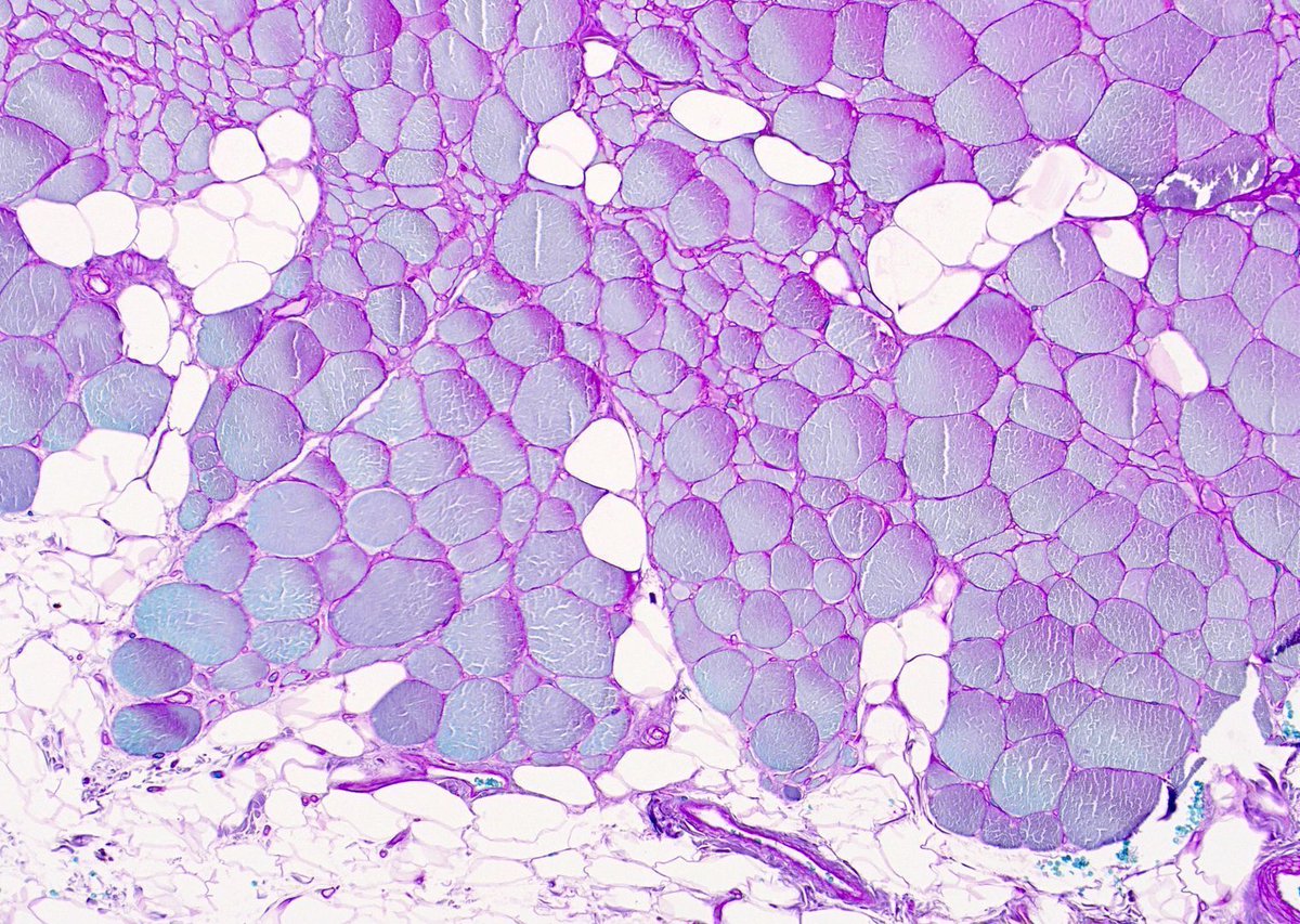 JMGardnerMD's tweet photo. What are these beauties?! They remind me of green-pink soap bubbles! Bonus point if you can name the stain.
Answer ✅ https://t.co/2NdQ82ZoUV
More pics: https://t.co/DJLtsawcrv.
#pathology #pathologists #pathTwitter #dermpath #dermatology #dermatologia #dermtwitter #pathArt https://t.co/rEo3cQiIc6