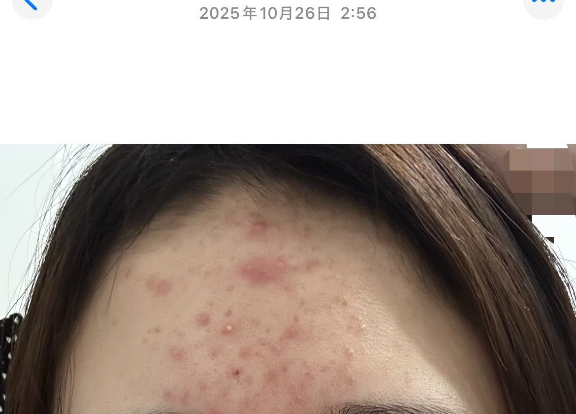 口の横のポニョ tweet media
