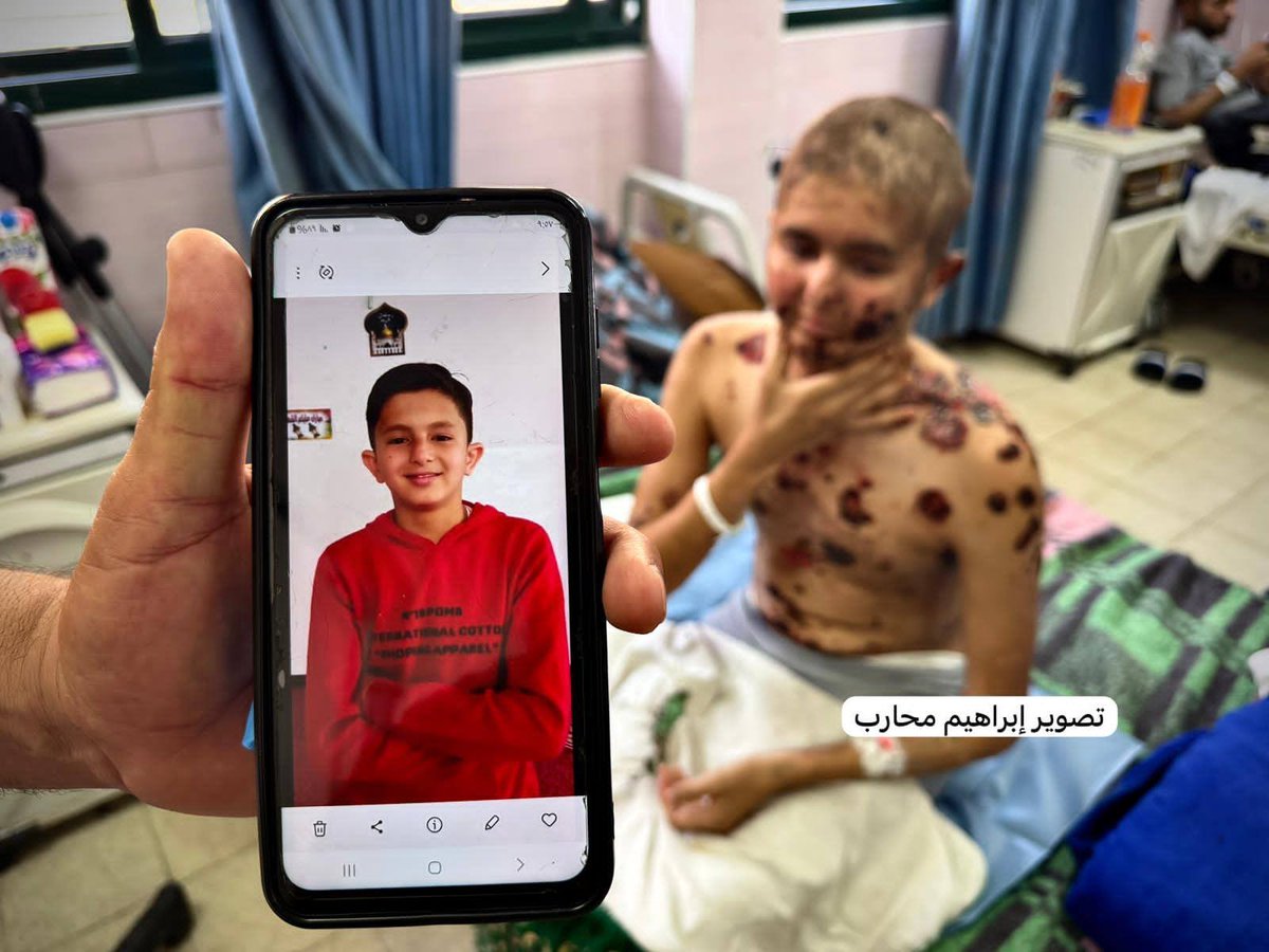 Mbdo95's tweet photo. الفتى عبد الله محمود الرقب (18 عامًا) كان يتمتع بصحة جيدة، ولم يكن يعاني من أي أمراض، قبل أن يُصاب برصاص الاحتلال أثناء محاولته الحصول على المساعدات الإنسانية.

وبعد إصابته، أُصيب بمرض الفقاع الشائع الذي يفتك بالجسد، حيث أفاد الأطباء أن التقرحات بدأت تصل إلى العظام.

علاج عبد الله غير متوفر داخل القطاع، ويتطلب نقله بشكل عاجل إلى الخارج لتلقي العلاج، تناشد عائلته كل صاحب ضمير حي التدخل العاجل لإنقاذ حياته قبل فوات الأوان.

#أنقذوا_مرضى_غزة