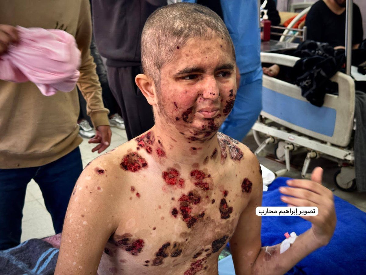 Mbdo95's tweet photo. الفتى عبد الله محمود الرقب (18 عامًا) كان يتمتع بصحة جيدة، ولم يكن يعاني من أي أمراض، قبل أن يُصاب برصاص الاحتلال أثناء محاولته الحصول على المساعدات الإنسانية.

وبعد إصابته، أُصيب بمرض الفقاع الشائع الذي يفتك بالجسد، حيث أفاد الأطباء أن التقرحات بدأت تصل إلى العظام.

علاج عبد الله غير متوفر داخل القطاع، ويتطلب نقله بشكل عاجل إلى الخارج لتلقي العلاج، تناشد عائلته كل صاحب ضمير حي التدخل العاجل لإنقاذ حياته قبل فوات الأوان.

#أنقذوا_مرضى_غزة