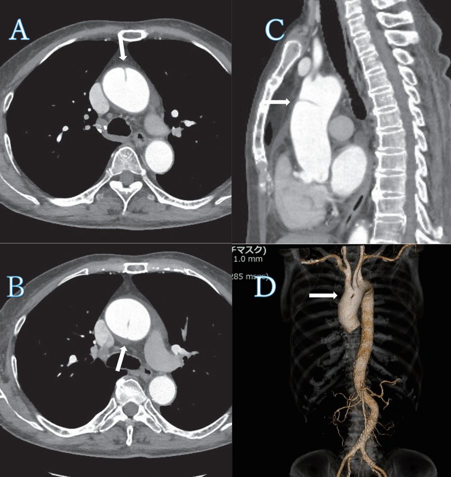 Intra-aortic cord(大動脈内索状構造) ☑管腔を横断する胎生期の線維性遺残(?) ☑抗凝固療法や手術は不要 ☑好発:弓部〜下行 ...