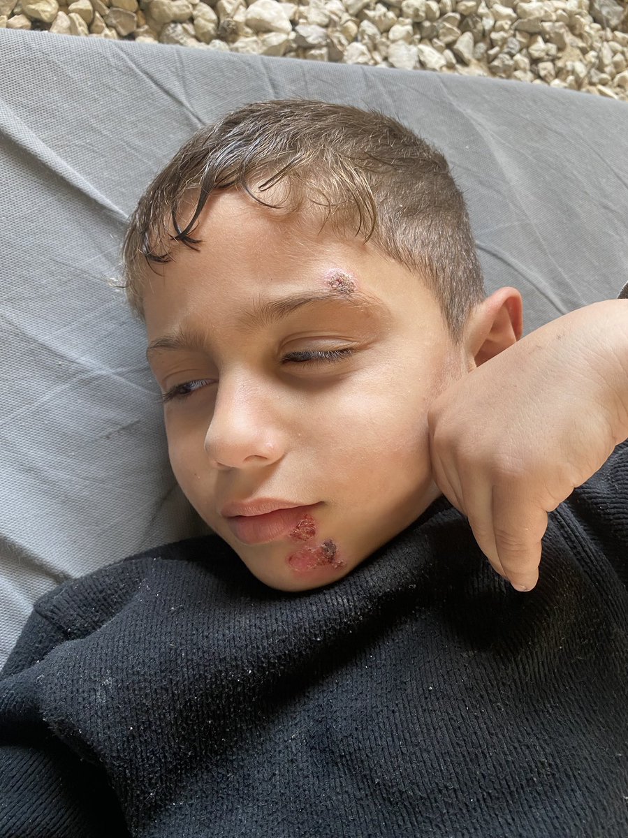 This is Ahmad… a child suffering in silence. The wounds on his face are increasing, and with them our helplessness grows. Please share his story—perhaps your voice can be his salvation 🤍
chuffed.org/project/mahmou…