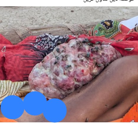 Maliks38974's tweet image. A little girl is fighting cancer and needs urgent help for her treatment. Every donation and share can make a difference. 💔🙏

📞 Contact: (03496468373)
💳 Donation Details: (eayspas 03496468373)

#HelpNeeded #CancerAwareness #Donate