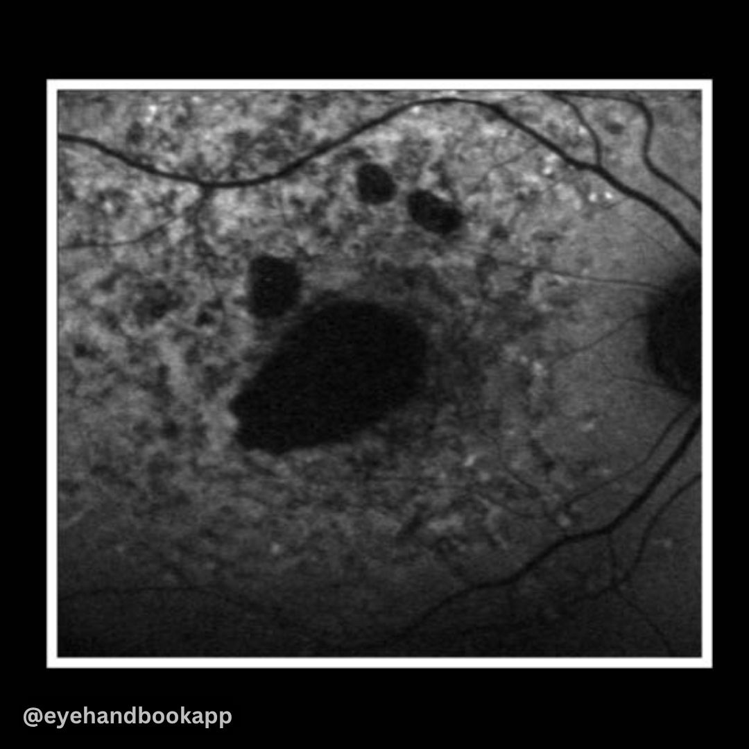 EyeHandbook's tweet photo. What is your diagnosis?
#eyes #eyecare #oftalmologia #ojos #eyesurgeons #ophthalmologist #eyecareproviders #optometrist #ocular #eyedoctors #ophthalmologyresidents #optometry #optometrystudents #ophthalmologylife #optometryschool #optometrysta #optometrylife https://t.co/aqK1s1BTcT