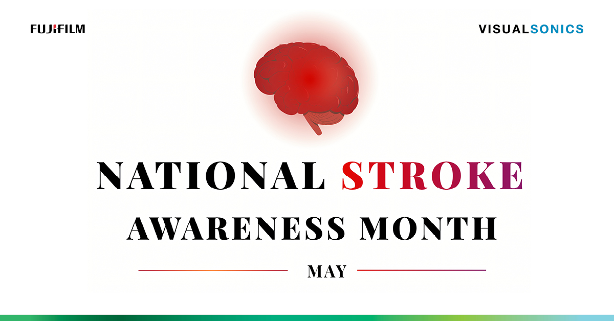 VisualSonics's tweet image. May is Stroke Awareness Month.

Visit visualsonics.com/application/pr… for information and resources on stroke imaging using the Vevo Imaging Systems.

#seeingmorematters #visualsonics #stroke #awareness #ultrahighfrequency #ultrasound #imaging #research