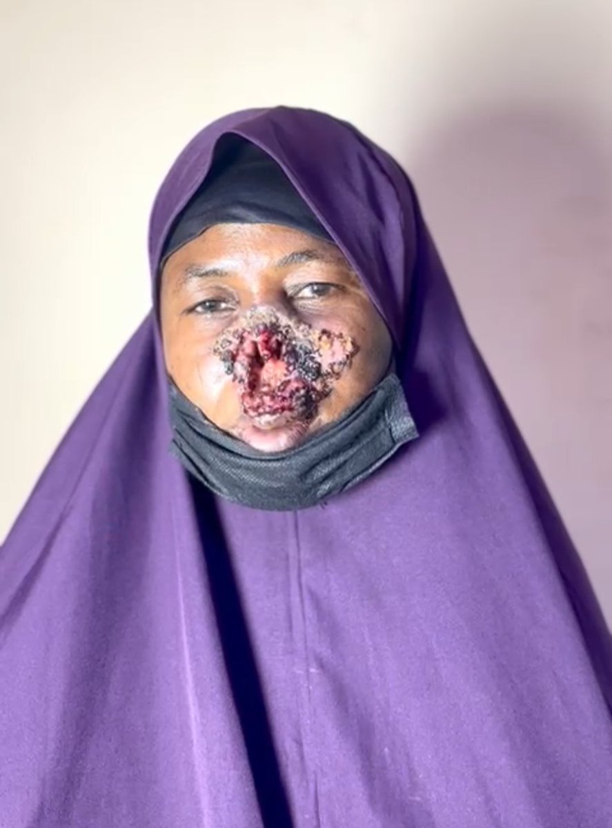 Zahra_Relief_F's tweet photo. All she needs is the ability to breathe.

 For 15 years, Malama Saudatu Usman has been battling nasal cancer, turning the simplest act into daily pain. At 46, she only wants a life without suffering.

1.

#SaveLife
#Help
#HealthcareLeadership https://t.co/4mHq5QBiol