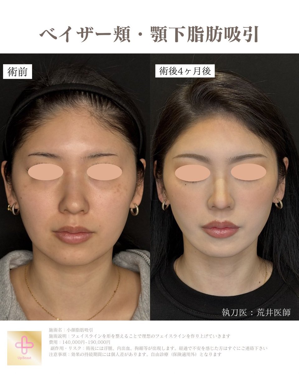 UBクリニック錦糸町院長👩‍⚕️荒井香織@目元整形、クマ取り、ベイザー脂肪吸引の美容外科医 tweet media
