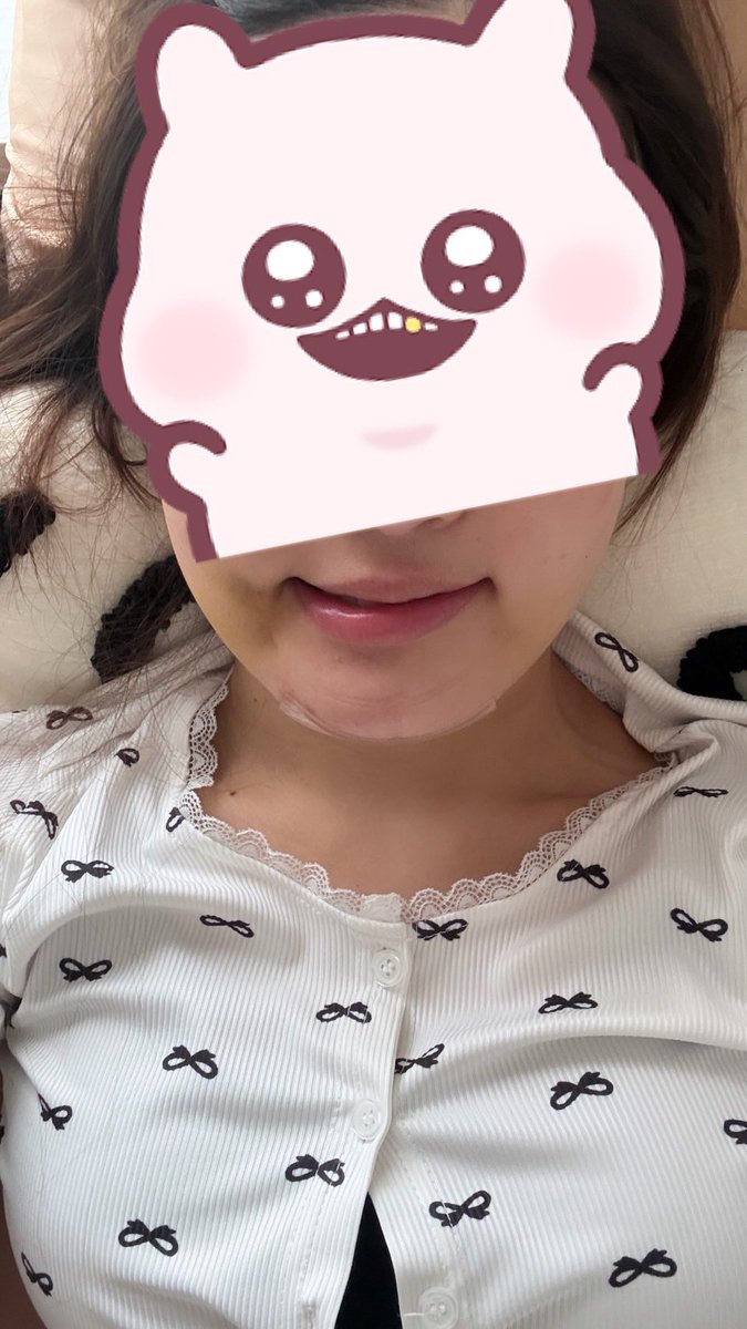 remiuta's tweet photo. DT1週間目💉
施術はジョールファットとペリカン施術
笑うと片方の口角が上がらない、、、。

徐々に治るのだろうか、。
不安すぎてDT鬱なGWを過ごしております😇😇 https://t.co/VPo5khY9JT