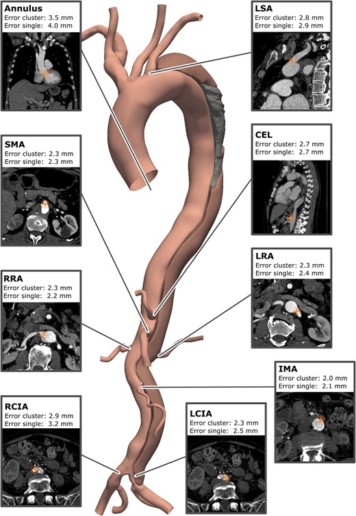SusannaLeeRad's tweet photo. Automated AI tool to identify and measure every branch vessel involved in a Stanford type B aortic dissection on CT.  Treatment planning and followup just became quantitative! @RSNA @OxfordJournals #RadAdv
https://t.co/UDCsNDMsjD https://t.co/6RBPpsUA8Z