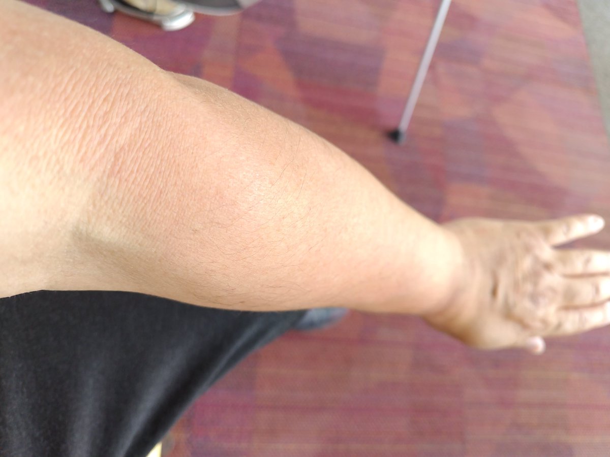 airmonkey0904's tweet image. うでの肌がヒリヒリ
4日のBBQで
日焼け防止しなかった
ツケが今来ている(-_-;)

＃日焼け
#BBQ
