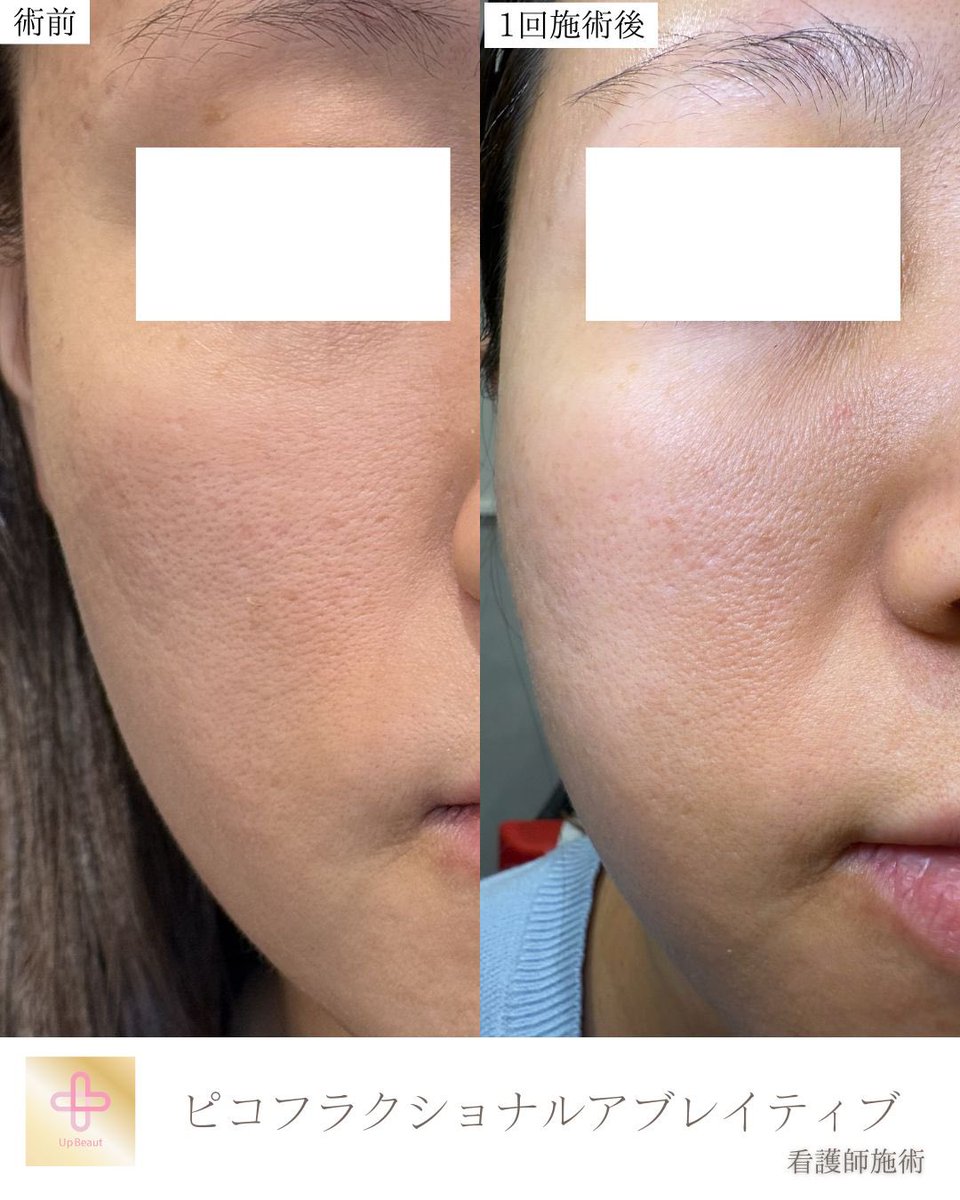 UBクリニック錦糸町院長👩‍⚕️荒井香織@目元整形、クマ取り、ベイザー脂肪吸引の美容外科医 tweet media