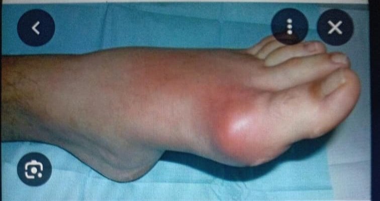 VICTORSILVES63's tweet photo. EL ÁCIDO ÚRICO Y EL CÁNCER DE COLON: Quienes padecen de ácido úrico tienen un mayor riesgo de padecer cáncer de colon débido a que los alimentos acidificantes dificultan la eliminación del ácido úrico , razón por que se recomienda una dieta alcalinizantes.
ALIMENTOS ACIDIFICANTES https://t.co/JK1e5MJyLv