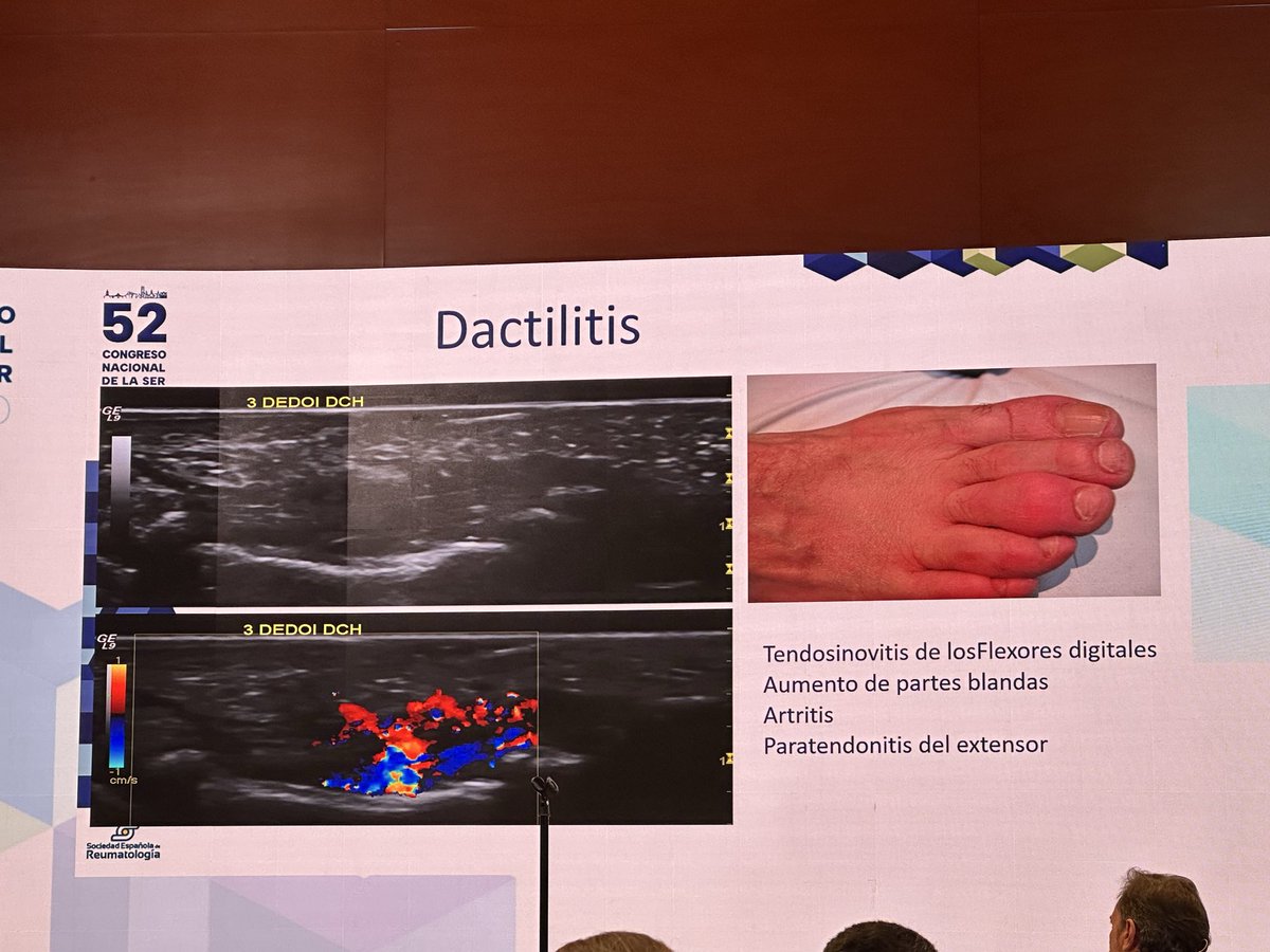 GRESSER_Espa's tweet photo. Qué es La dactilitis? Sabéis que podemos encontrar? #SER2026 👇@SEReumatologia El Dr De Miguel nos lo cuenta https://t.co/zGSrX44Mec
