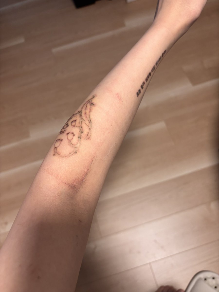 mmklena's tweet photo. タトゥー除去ダウンタイム1週間経過
毎日ドルマイシン塗ってガーゼの上から冷やしてたから今のところ膿んでない🙂
#タトゥー除去 #タトゥー除去大阪 https://t.co/otQTINzkTK