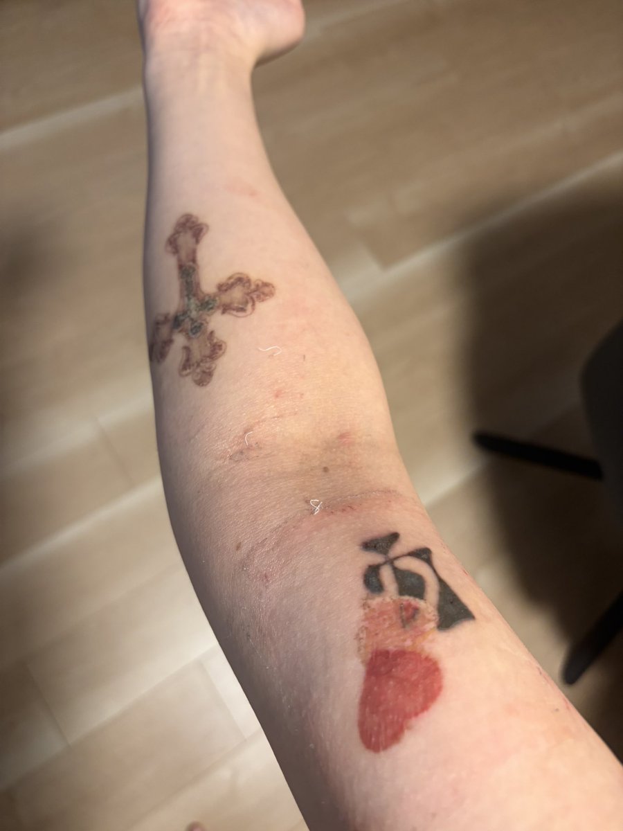 mmklena's tweet photo. タトゥー除去ダウンタイム1週間経過
毎日ドルマイシン塗ってガーゼの上から冷やしてたから今のところ膿んでない🙂
#タトゥー除去 #タトゥー除去大阪 https://t.co/otQTINzkTK