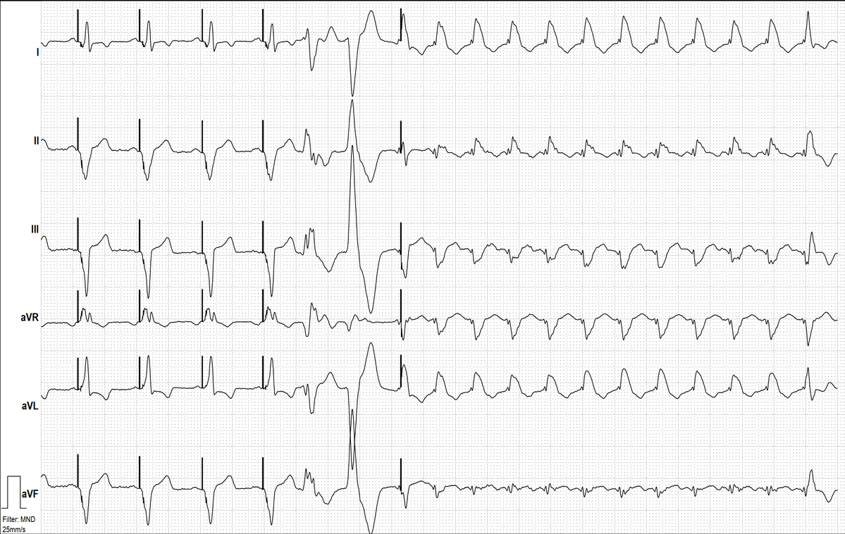 ecgandrhythmRoe's tweet photo. A80 yo pacemaker patient with intermittent palpitations. What`s your take? https://t.co/zbZRwGFAO0