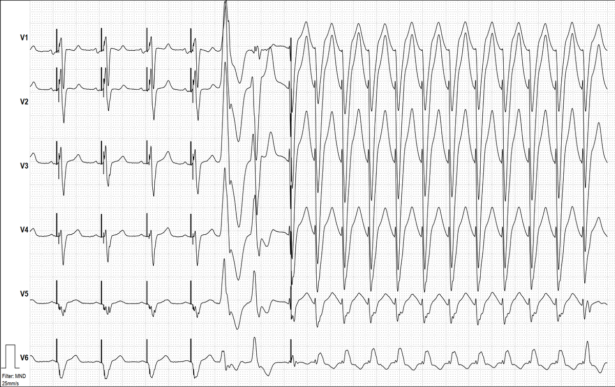 ecgandrhythmRoe's tweet photo. A80 yo pacemaker patient with intermittent palpitations. What`s your take? https://t.co/zbZRwGFAO0