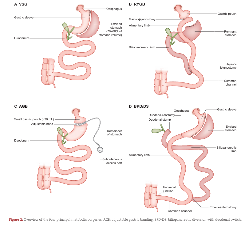 NDTsocial's tweet photo. Obesity as a modifiable risk factor in patients with chronic kidney disease

🆓https://t.co/NClkFURVVY https://t.co/RrSx7iBwKX