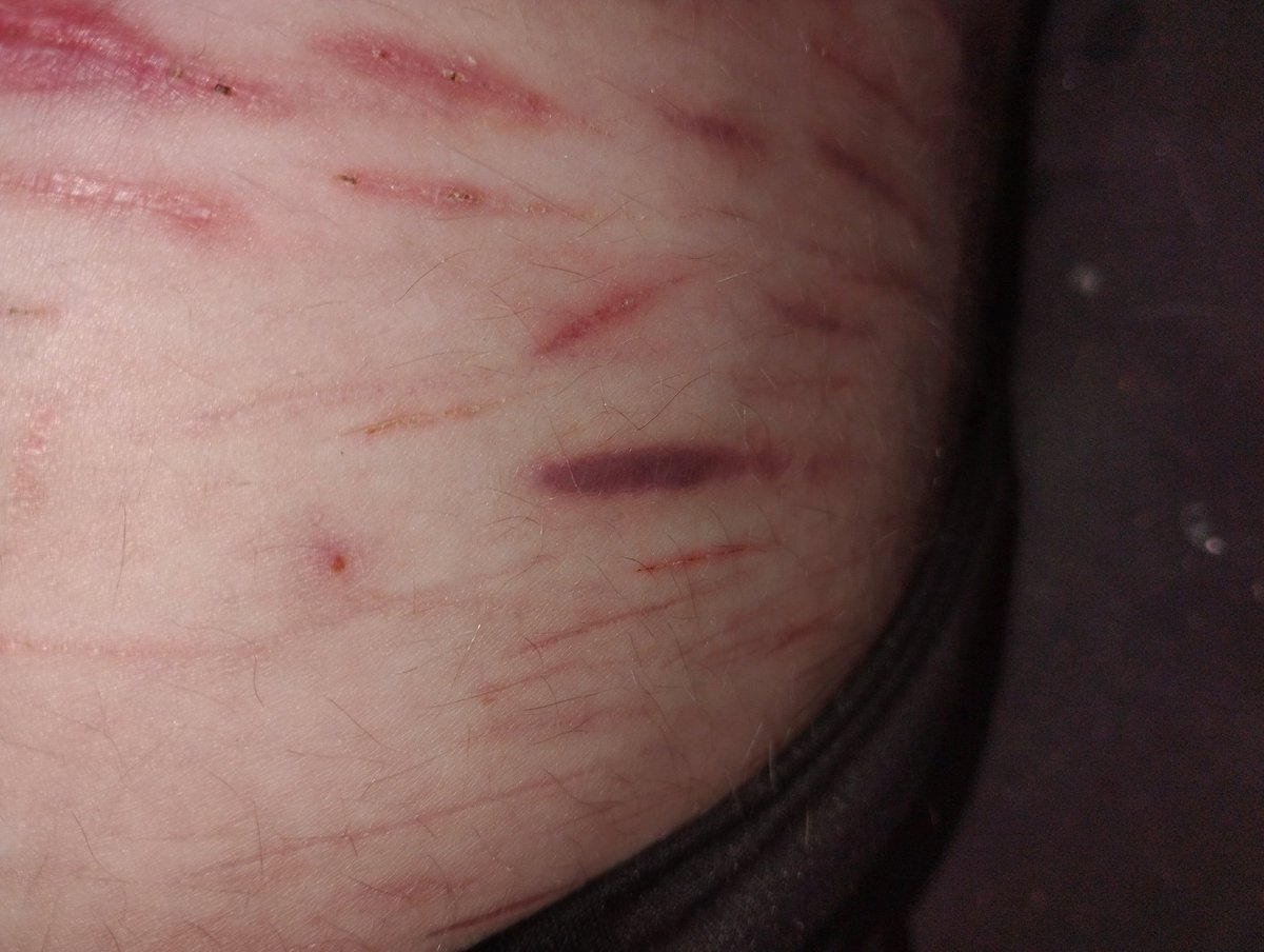 Ash15552's tweet photo. @Ash15552 scar update from my pinned post
#shtwt https://t.co/xFBp2yjmZL