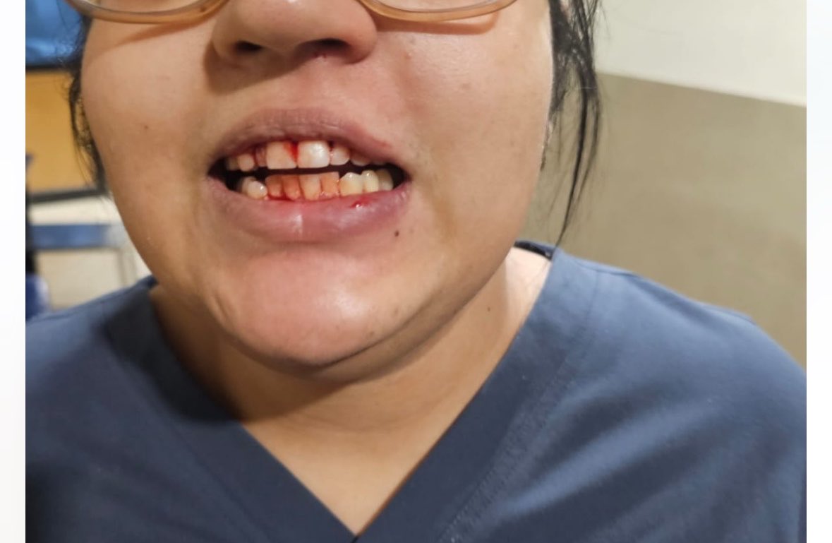 Meetmbbs07's tweet photo. A shocking incident has emerged from JNMC Hospital, Aligarh Muslim University, where a female resident doctor was brutally assaulted by a mob accompanying a patient. The attack left her with severe oral injuries, while another doctor sustained serious trauma, including a fracture https://t.co/pzxaPaweBT