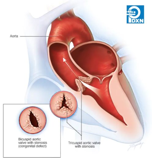 PDXN1's tweet photo. Aortic valve stenosis is a type of valvular heart disease. The valve between the lower left heart chamber and the Aorta is narrowed and doesn't open fully. This reduces/blocks blood flow from the heart to the aorta &amp; to the rest of the body. Treatment depends on the severity. https://t.co/TIwFBdTDtt