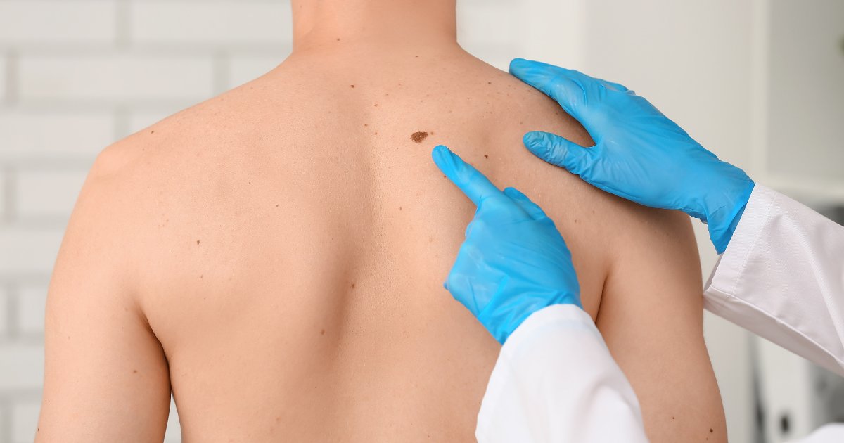 #MelanomaDay oggi alla Camera, un momento di confronto tra istituzioni, medici, ricercatori e associazioni pazienti per ribadire un messaggio chiaro: serve più #prevenzione e diagnosi precoci. Continua l'articolo: medinews.it/comunicati/mel…
