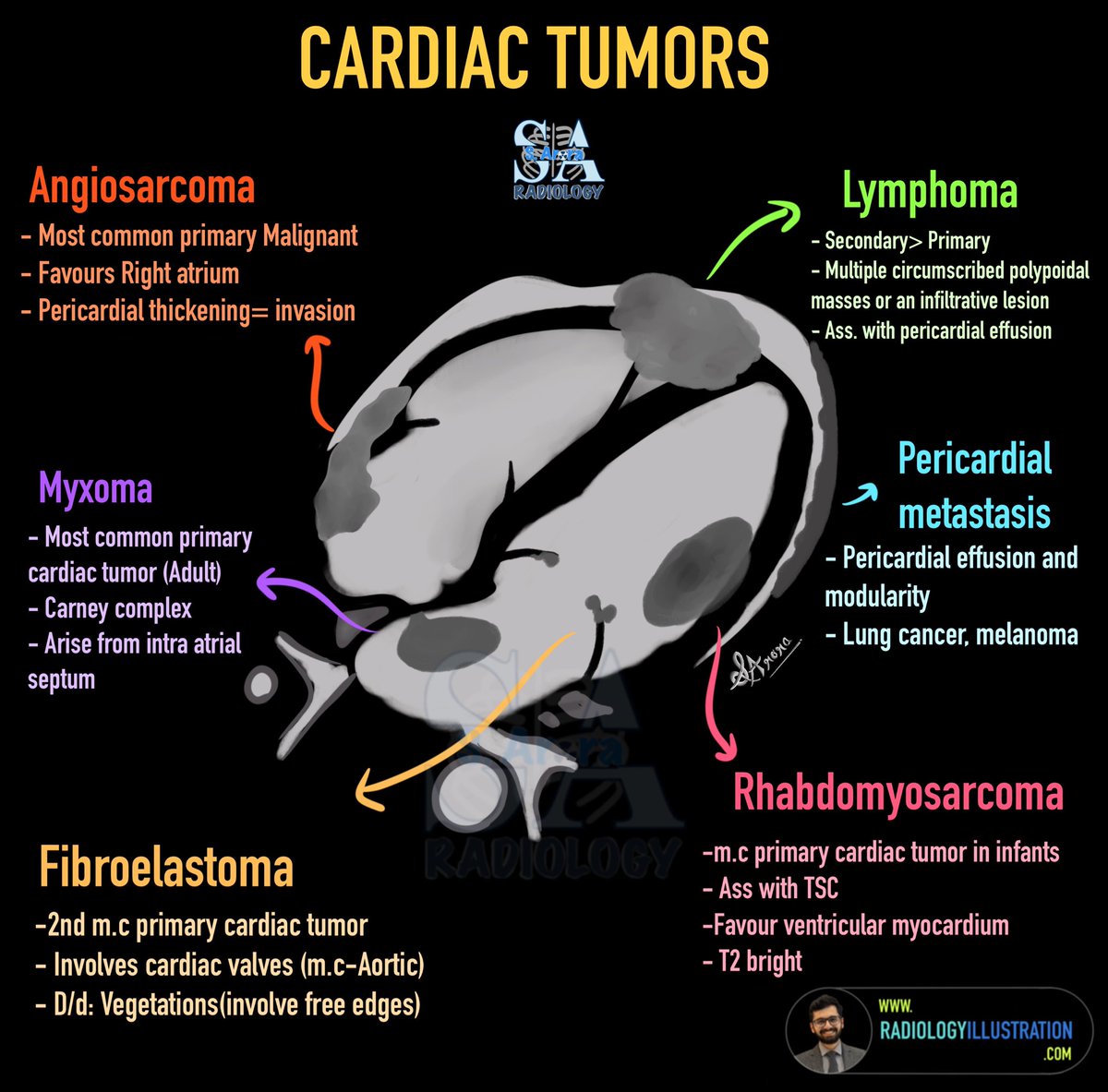 Slide on cardiac tumors. 

#radiologyillustration
