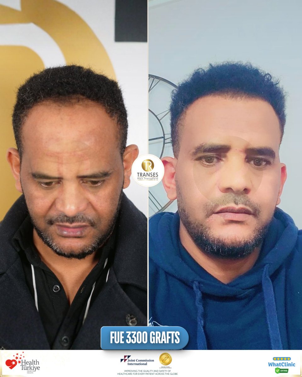 transeshair's tweet photo. This hair transplant operation was performed at Istanbul Tema Hospital BHT Clinic.
15 years of experience with a 4.9 ⭐ WhatClinic rating.
FUE • DHI • HYBRID • PRP
Natural results, professional care.

#YourJourneyYourTransformation
#TransesHairTransplant
#FUE #DHI #PRP https://t.co/AR1LuzCEbN