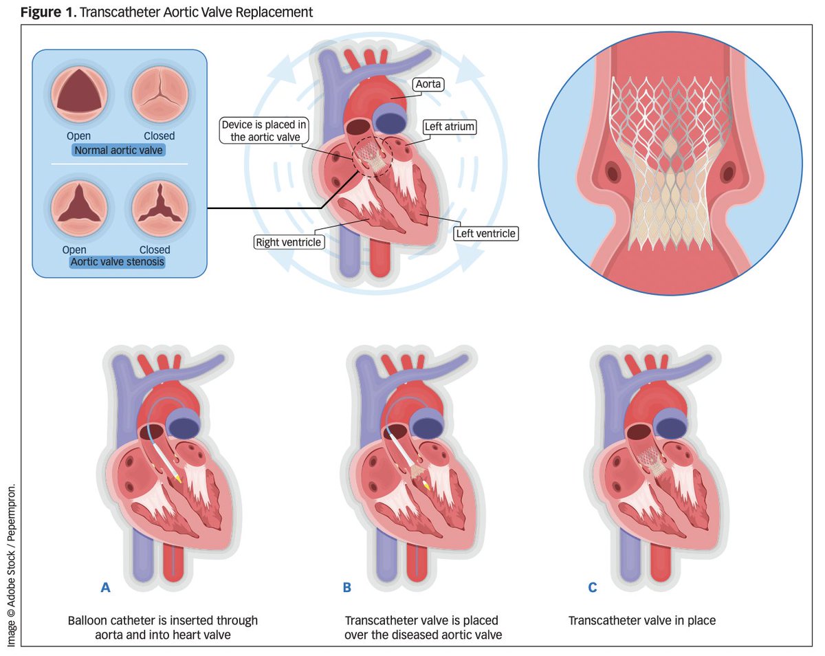 AmJNurs's tweet photo. Clinical Review: The Evolution of Transcatheter Aortic Valve Replacement: From Novel to Normal

the CE article in our May issue is free to read: 

https://t.co/5YCSnZRZfL

#nursingknowledge https://t.co/PI4wdI61aB