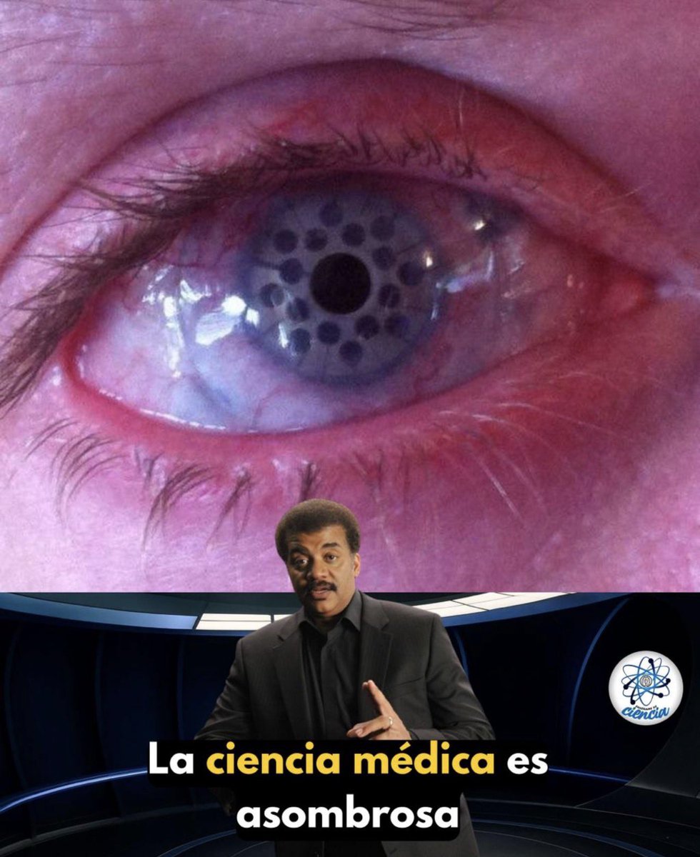 Lo que ves no es un ojo robótico, es una queratoprótesis, una prótesis ocular capaz de devolver la visión a personas que creían haberla perdido para siempre.

Cuando una córnea queda tan dañada que ni los trasplantes funcionan, la medicina da un paso más allá: reemplaza la córnea