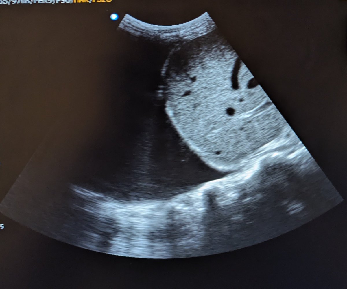 BrunoNatuhwera's tweet photo. Elderly with chest pain and DIB. 
Scan in the RUQ. What do we have here and what are the common causes? https://t.co/7HELkmeqIn
