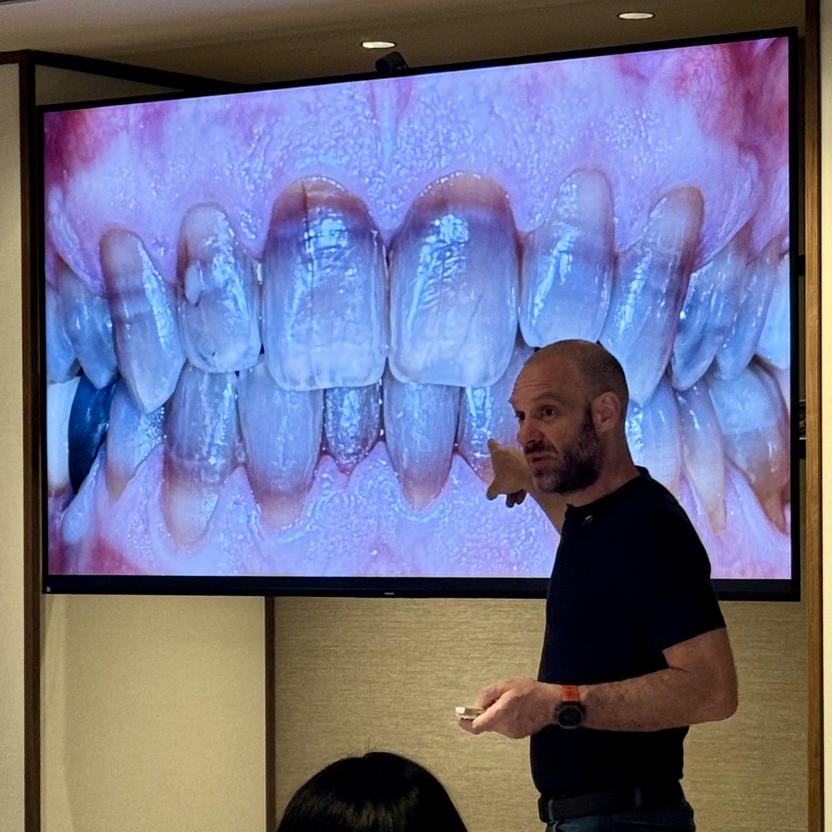 amdlasers's tweet photo. Is Sheer White! in your toolbox? 🧰

During a Monday lecture for Style Italiano in Milan, Italy, Dr. Jordi Manauta showed the role Sheer White! strips can play in post-endo aesthetic treatment to help revive even the most complex dark teeth cases. https://t.co/iSqqYeupOZ