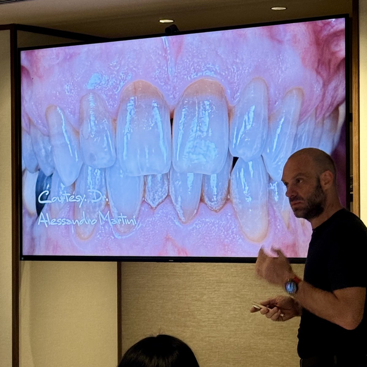 amdlasers's tweet photo. Is Sheer White! in your toolbox? 🧰

During a Monday lecture for Style Italiano in Milan, Italy, Dr. Jordi Manauta showed the role Sheer White! strips can play in post-endo aesthetic treatment to help revive even the most complex dark teeth cases. https://t.co/iSqqYeupOZ