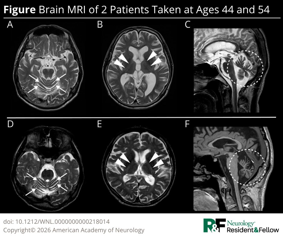 Teaching #NeuroImage: Bilateral Posterior Limb Internal Capsule T2 Hyperintensity and Severe Cerebellar Atrophy in 2 Lifelong Friends hubs.la/Q04dWGng0

#NeurologyRF