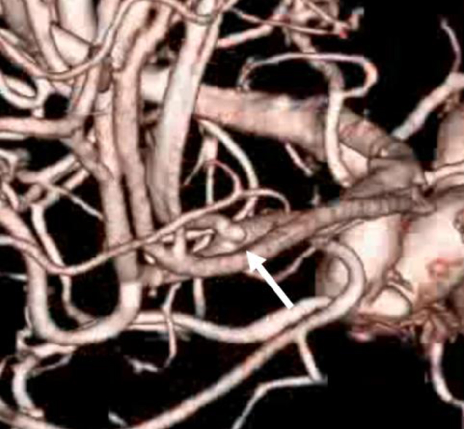 Neuro_Res's tweet photo. Transient Akinetic Mutism Following Partial Corpus Callosum Infarction After Rupture of a Distal Anterior Cerebral Artery Microaneurysm
https://t.co/4cOJBXJLQ0

#MedTwitter #Medicine #MedicalResearch #Neurology #ElmerPress https://t.co/RAbVIrkM47