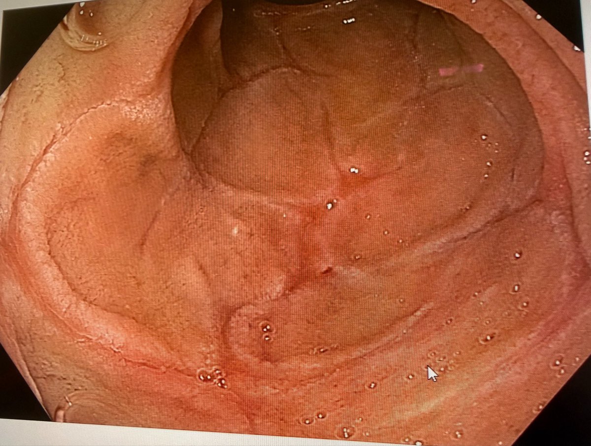 IvetteSLomeli's tweet photo. Has anyone seen this in duodenum?
This is 64 yo Female 
✅epigastric pain only
✅ Chronic Constipation 
✅ Long time Smoker https://t.co/JpwvlEPJuv
