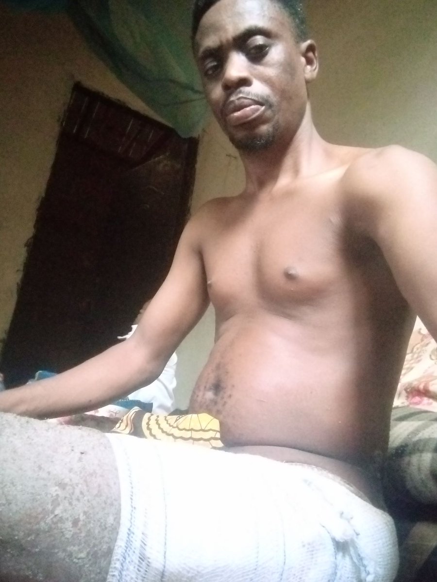 gaius231's tweet photo. @_dinomelaye My brother my friend needs help 
He had an accident two years ago and this had been his state from one hospital to another for treatment and ubth wanted to amputate the leg instead he had to undergo another surgery 
Bill for the surgery was 4.5m 
But he was able to raise 2m https://t.co/VHVne1M92L