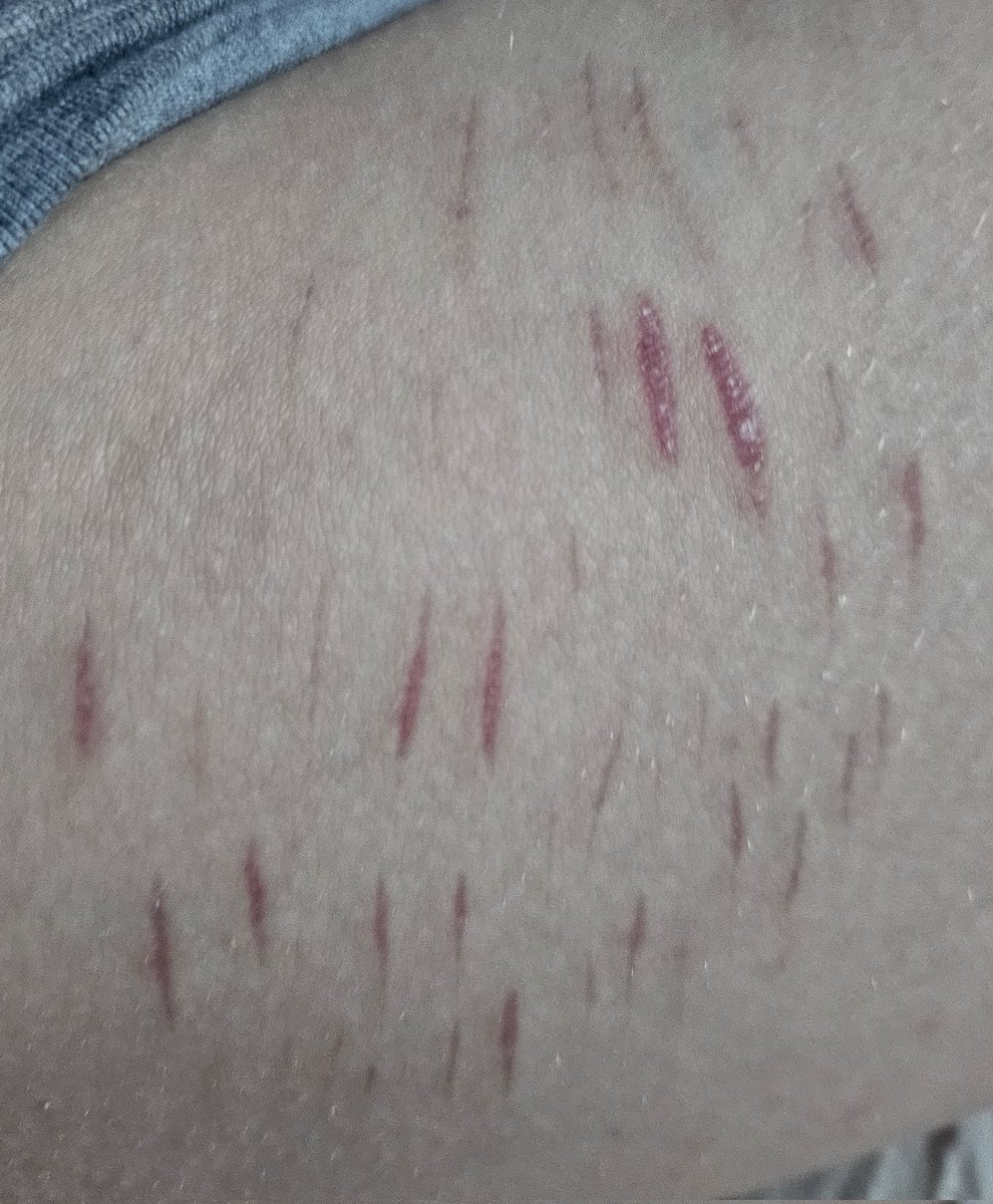 1Acid_queen1's tweet photo. Will they scar? #shtwt #shed
#shtwt https://t.co/EsanUuAyTg