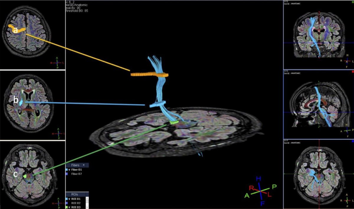 Neuro_Res's tweet photo. Comparison of Diffusion Tensor Imaging Parameters Associated With Motor Fiber Injury Between Patients With Chronic Subdural Hematoma and Intracerebral Hemorrhage
https://t.co/4MLpt7uwew

#MedTwitter #Medicine #Neurology #ElmerPress https://t.co/qPoz0NnaVr