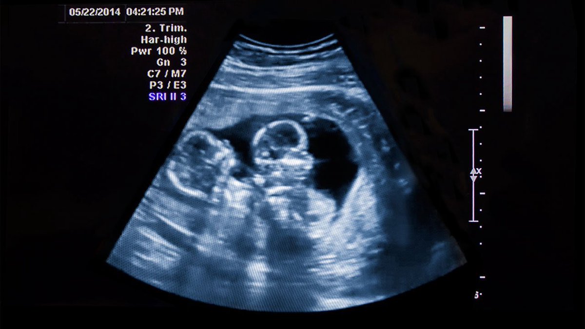 IHalemee's tweet photo. Rihanna currently pregnant with twins 

So fertile ❤️. https://t.co/WqlhHI7Qfj