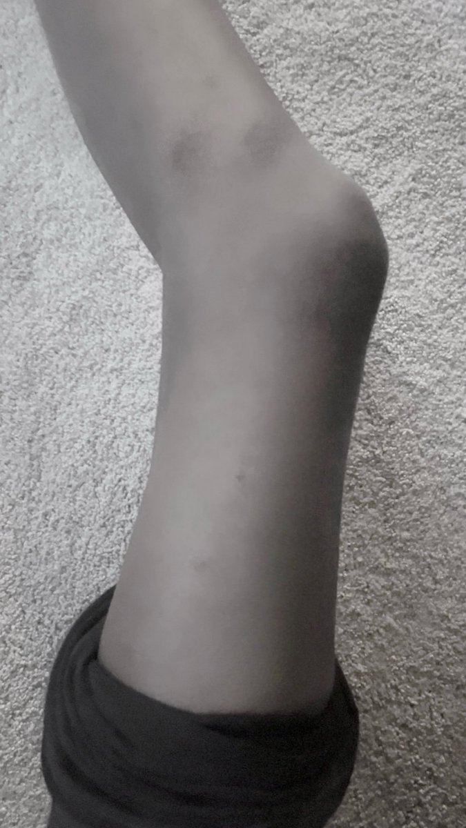 lambloli's tweet photo. so  many  bruises  on  mai  leg https://t.co/ZDEA62FWC5
