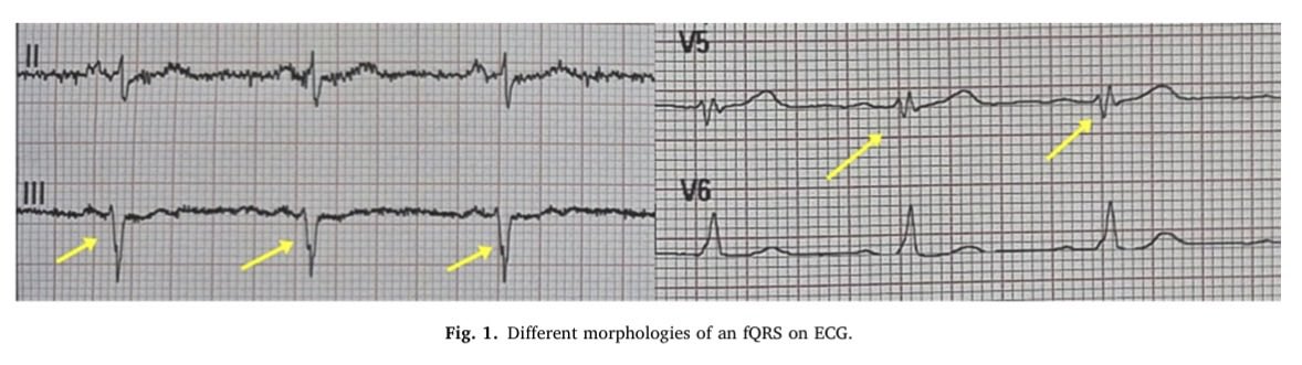 JElectrocardiol's tweet photo. 🔬Research Alert 

🫀In patients with angina pectoris, the presence of fragmented QRS (fQRS) complexes was associated with ≥70% coronary stenosis on coronary computed tomography angiography (CCTA). 
🔗: https://t.co/lDFu0VI2Kj https://t.co/X4nWRRCodW