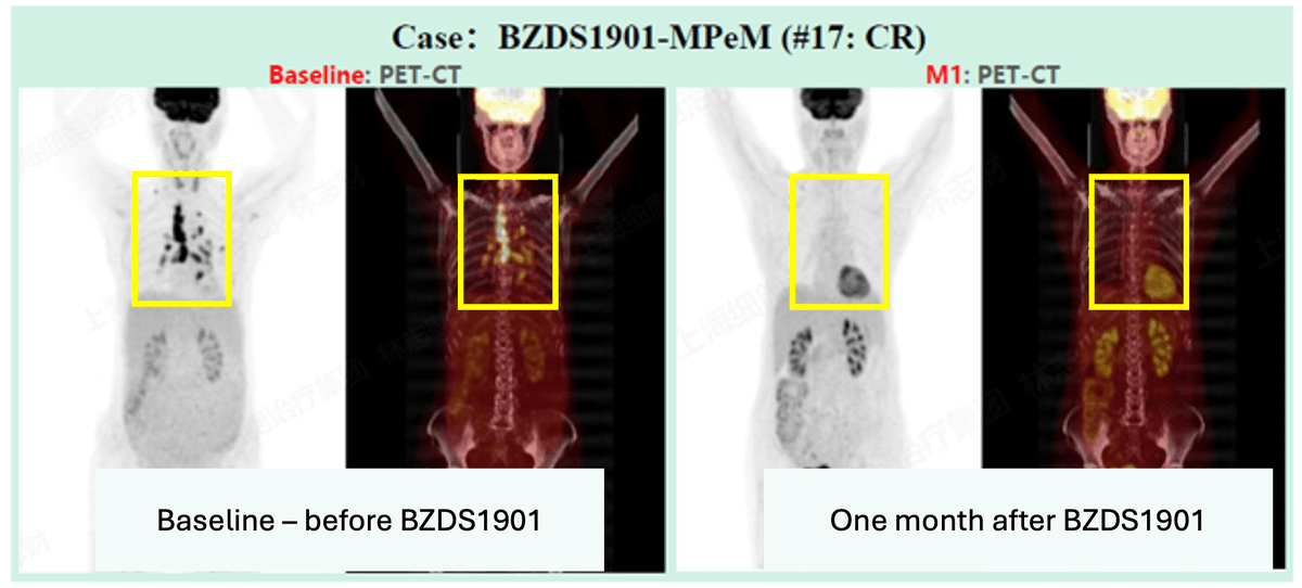 AdAlta1AD's tweet photo. AdAlta (ASX:1AD) Investor Webinar: New hope for mesothelioma patients - BZDS1901 clinical update

Monday, 11 May 2026

2:30 – 3:15 pm AEST

Register (free) here: https://t.co/mFzi4LUeZA https://t.co/zOOpEOVuVe