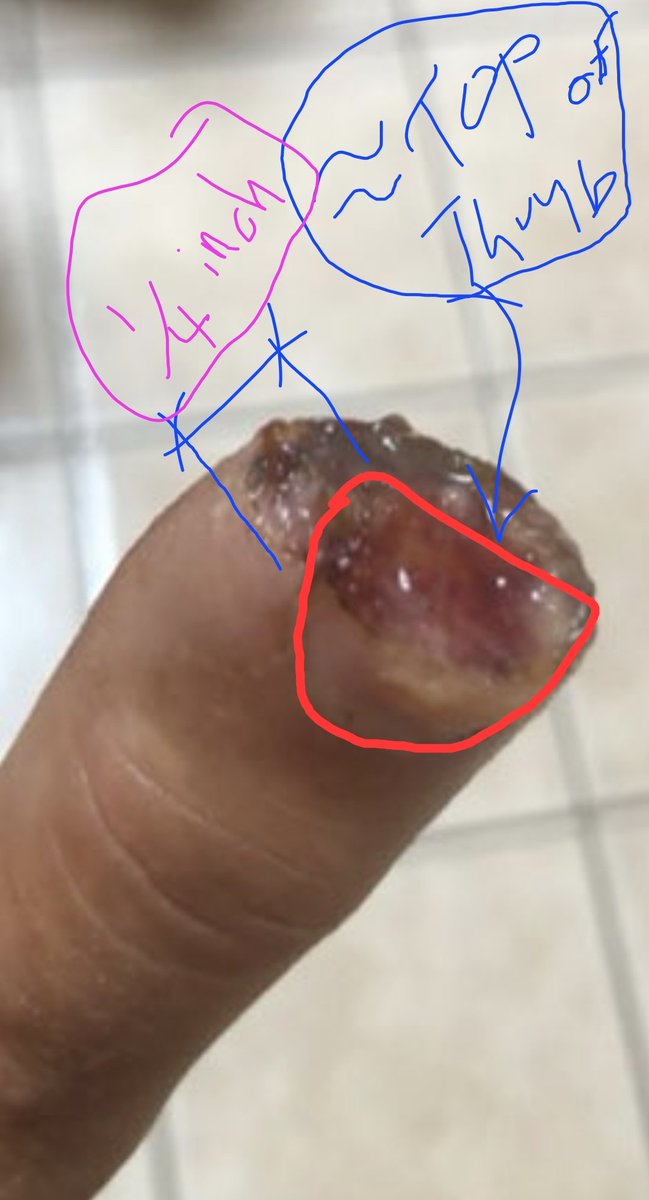 AQuizdom's tweet photo. @ChristelTe9055 @CMDRVALTHOR Thank you!

Unfortunately, you are still full of shit, 1/3 of the finger nail showing still...

You had the TIP cut off. Further, your NAIL grew back, your finger didnt >> it calloused over and the skin healed. 

Doc denied sewing back on bc you only lost 1/4" off the top. https://t.co/3zNStImWGd