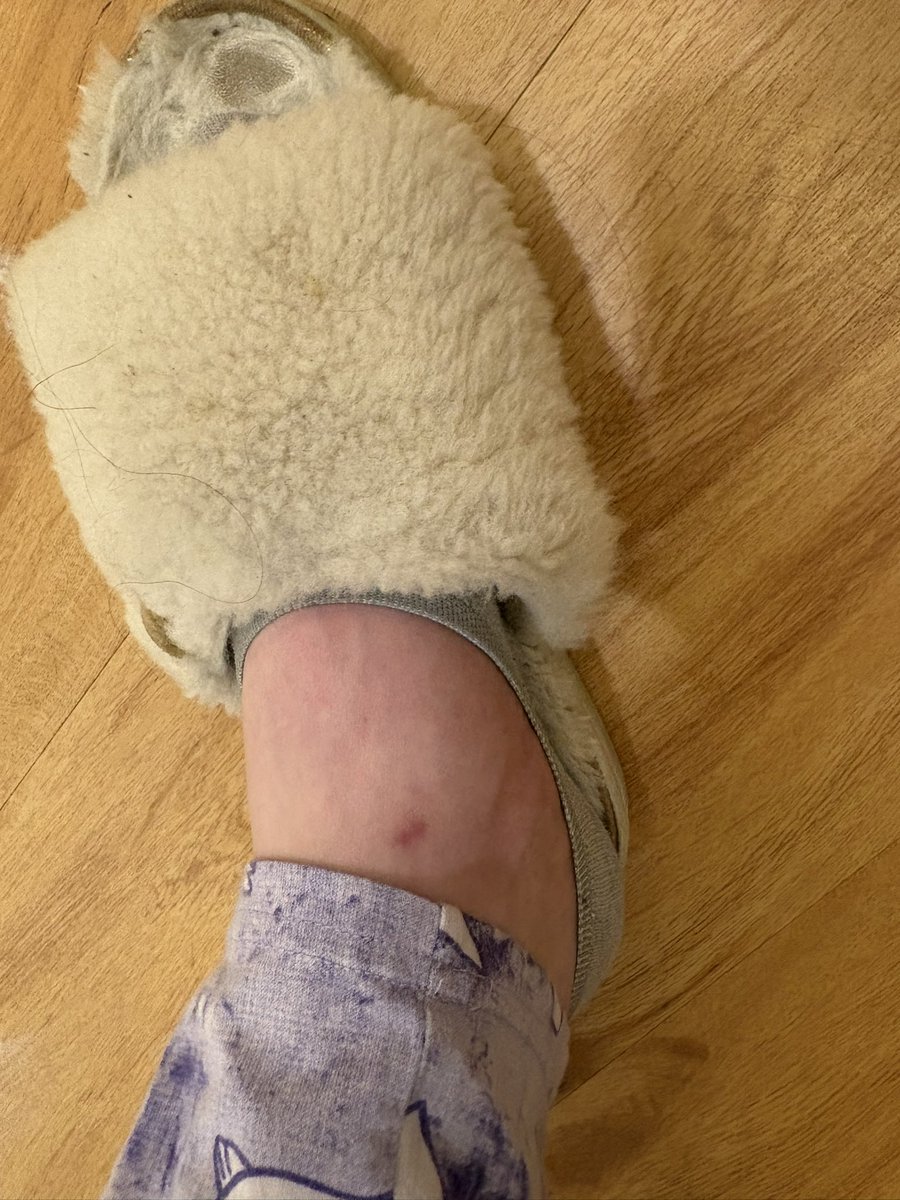 KalistaFact's tweet photo. On the other end of the spectrum to my fucked up toenail (too ugly and gross to photograph), I think this welt is really cute :3 https://t.co/P1mhrro245