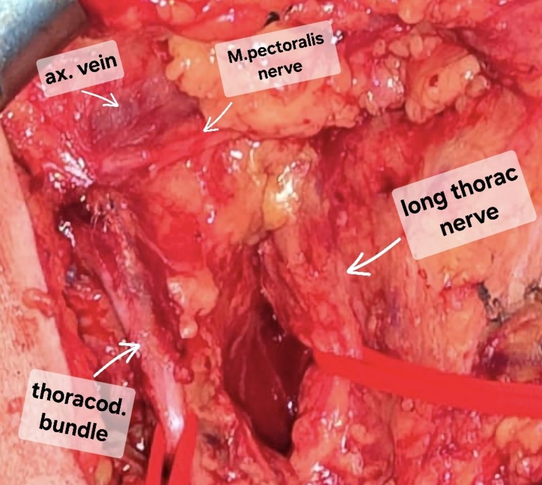 derdyail's tweet photo. Axillary lymph node dissection
Medial pectoralis nerve
Axillary vein
Long thoracic nerve
Thoracodorsal bundle 

@SAGES_Updates 
@SurgJournal 
@BreastCancerNow https://t.co/hmXlRVcSQ1